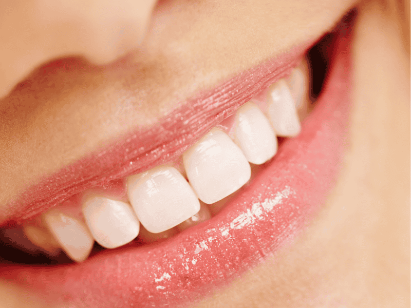 Lentes de Contato Dental: quanto tempo duram as lentes de contato dental?