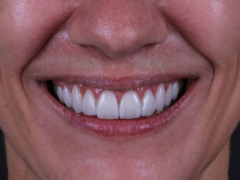 Qual a diferença entre Lente de Contato Dental e Faceta de Porcelana?