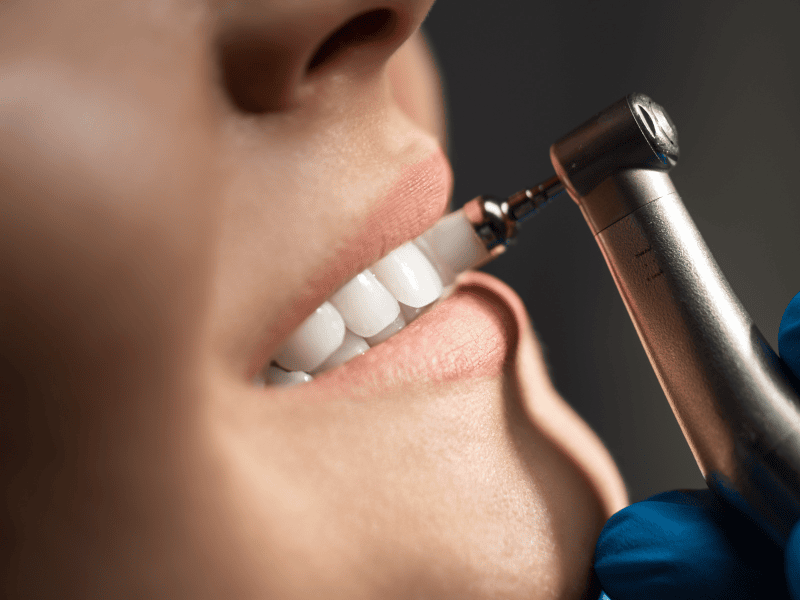 A Melhor Dentista de Porto Alegre para Lentes de Contato Dental em Porcelana