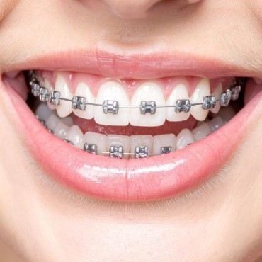 Aparelho Fixo Ortodôntico em Moinhos de Vento