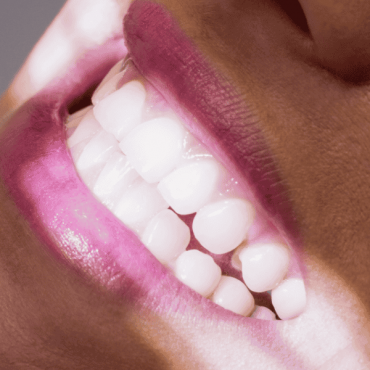 Lentes de Contato Dentais em Moinhos de Vento