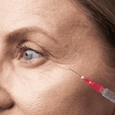 Preenchimento de Olheiras em Moinhos de Vento