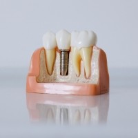 implantes-dentarios-em-porto-alegre-rs