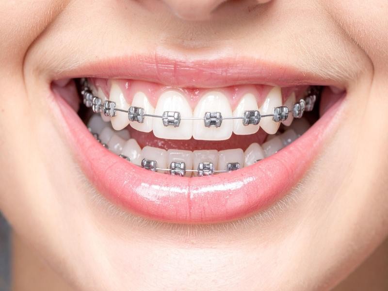 Aparelho Fixo Ortodôntico