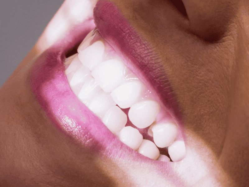 Lentes de Contato Dentais em Porto Alegre