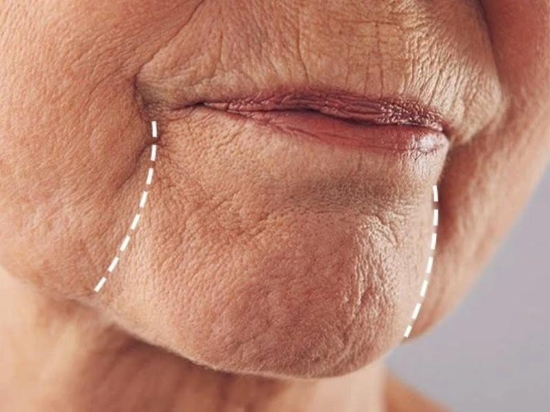 Preenchimento de Marionete em Porto Alegre em Capão da Canoa